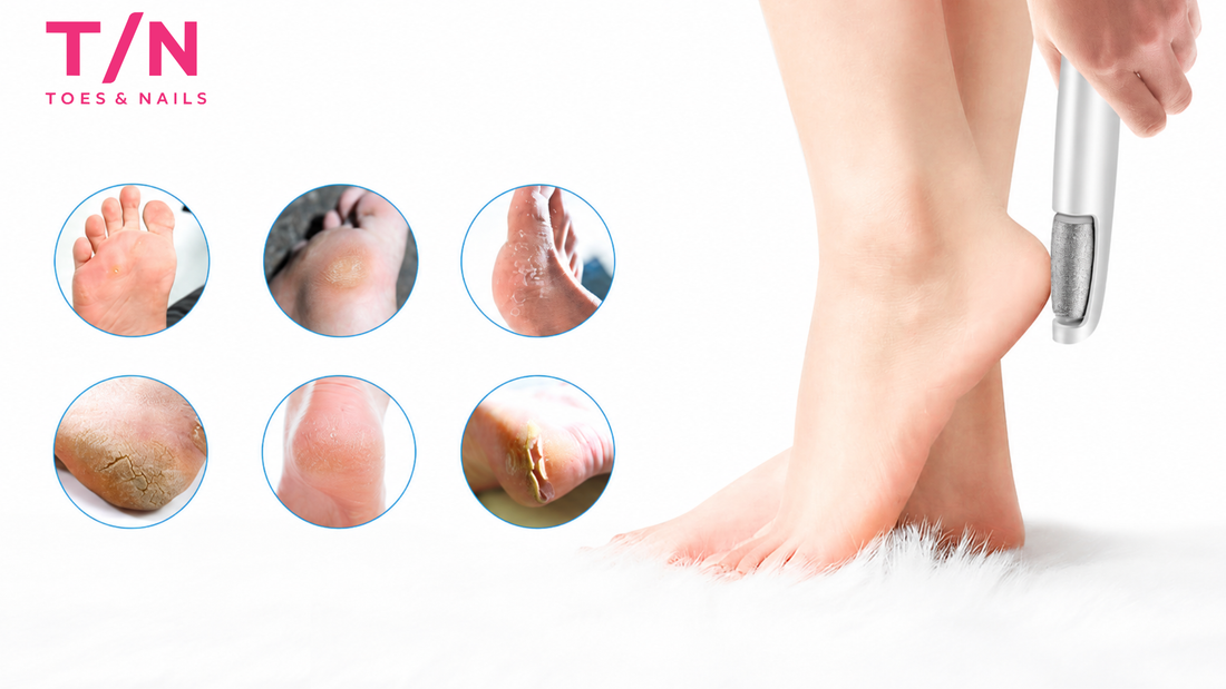 Callus Removal